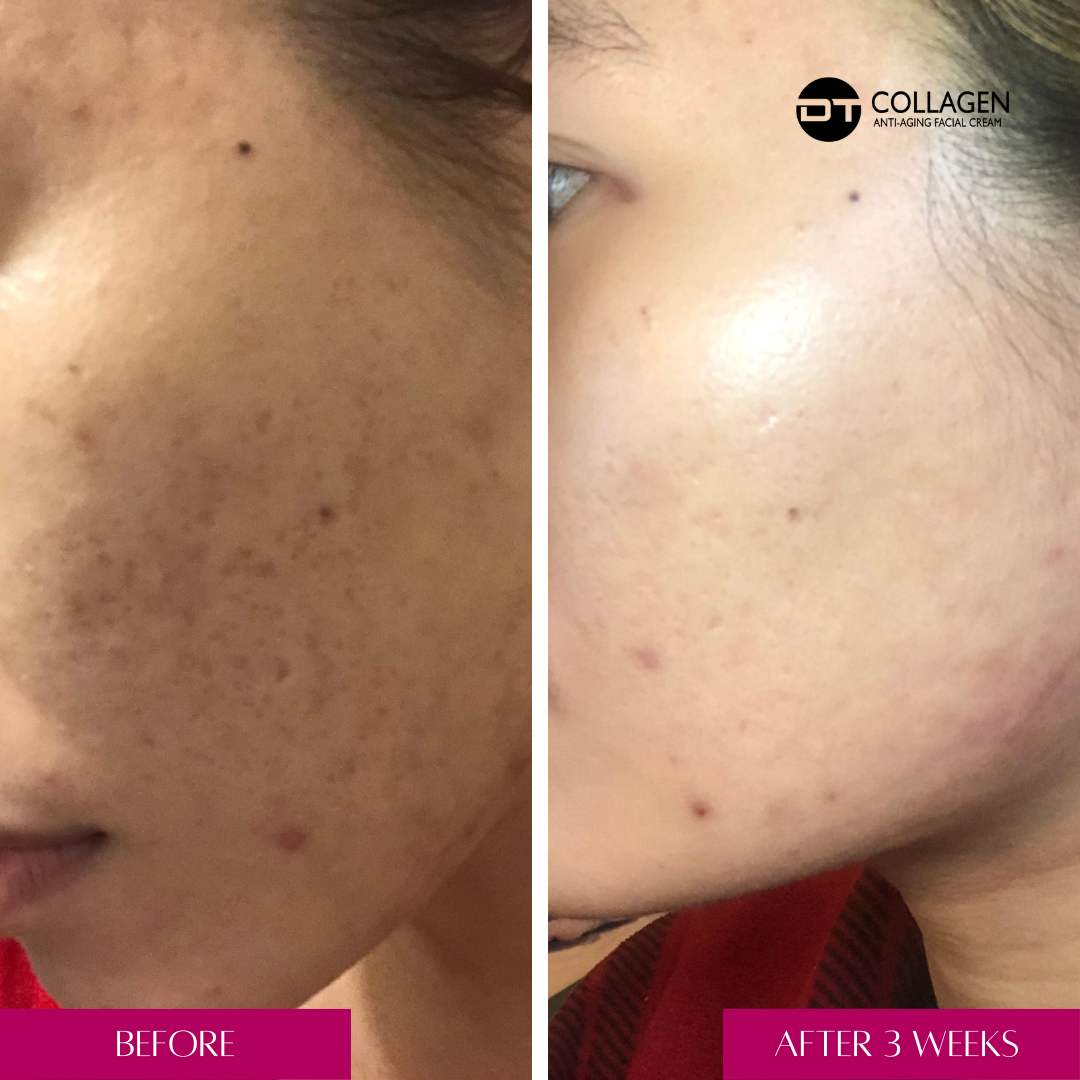 dt-acne-gel-before-after-image-treat-acne-dt-collagen-2