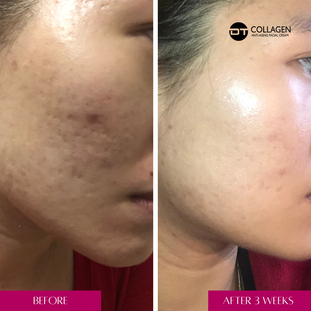 dt-acne-gel-before-after-image-treat-acne-dt-collagen-3
