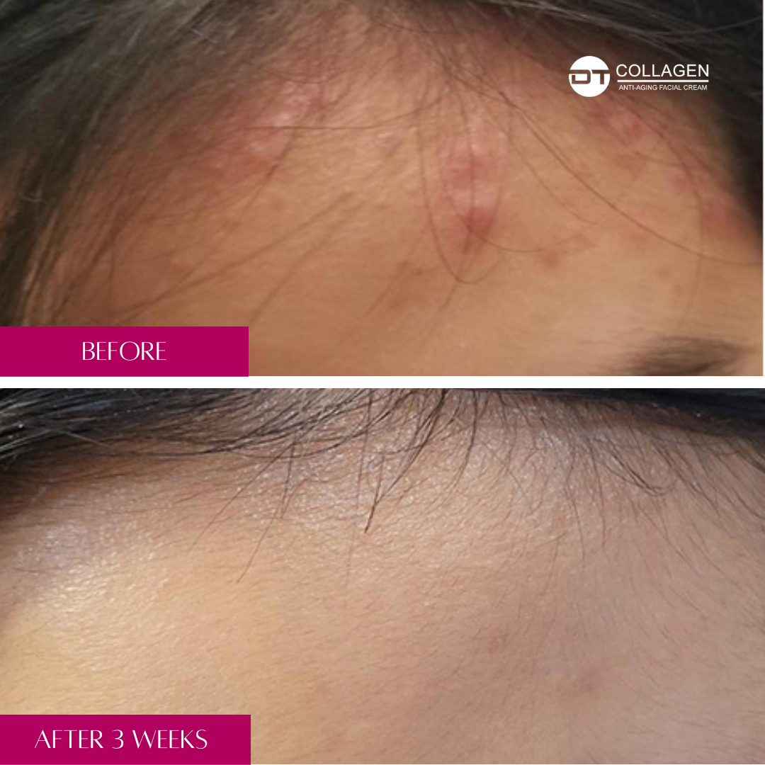 dt-acne-gel-before-after-image-treat-acne-dt-collagen-4